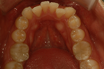Случай улучшения прикуса Перед лечением