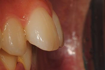 Устранение протрузии передних зубов - Случай 1 Перед лечением