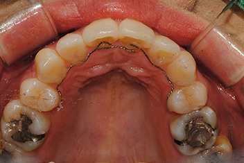 Устранение протрузии передних зубов - Случай 2 После лечения