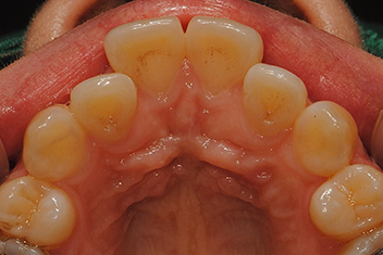 Устранение протрузии передних зубов - Случай 2 Перед лечением