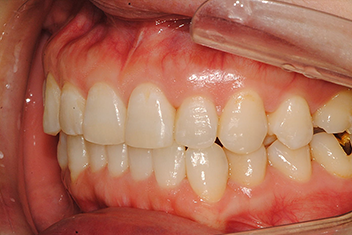 Улучшение выступающих губ После лечения