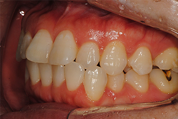 Улучшение выступающих губ Перед лечением