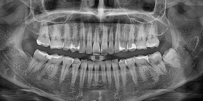 ការថតរូប X-ray មុនការវះកាត់